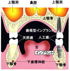 自然の歯とインプラントの違い